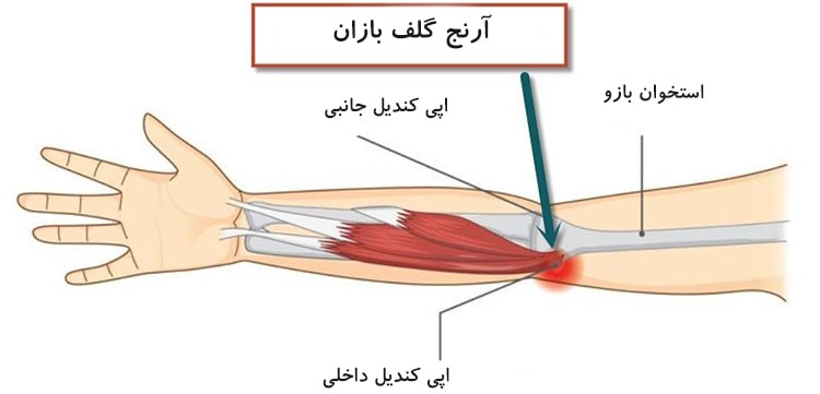 درد ارنج