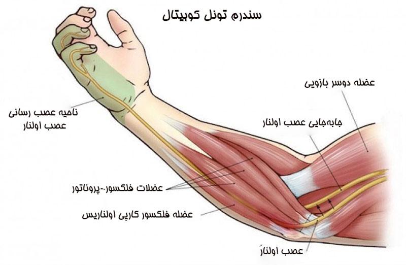 سندرم کوبیتال